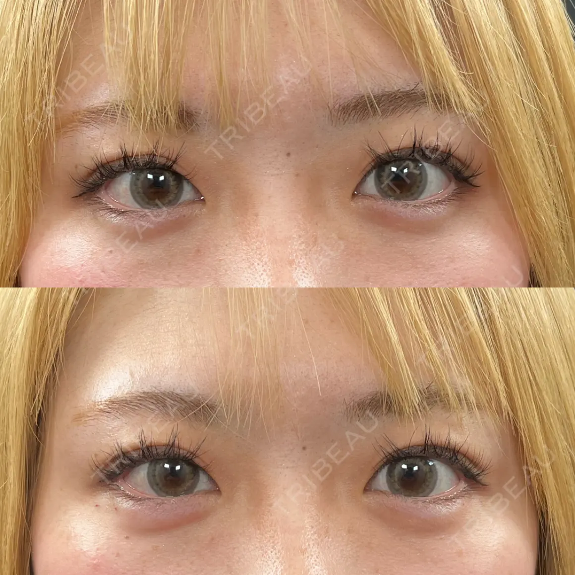 ヒアルロン酸注入（涙袋） THE FIRST CLINIC 町田院 AFTER
