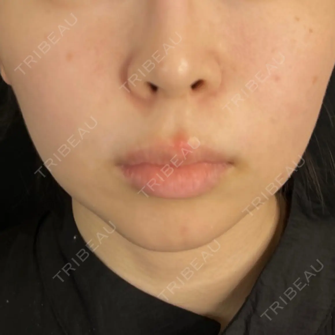 バッカルファット除去 / メーラーファット除去 藤・ナチュレ美容クリニック 銀座院 AFTER