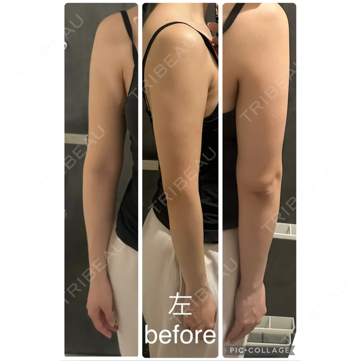 脂肪吸引（二の腕） オアシス美容外科 AFTER