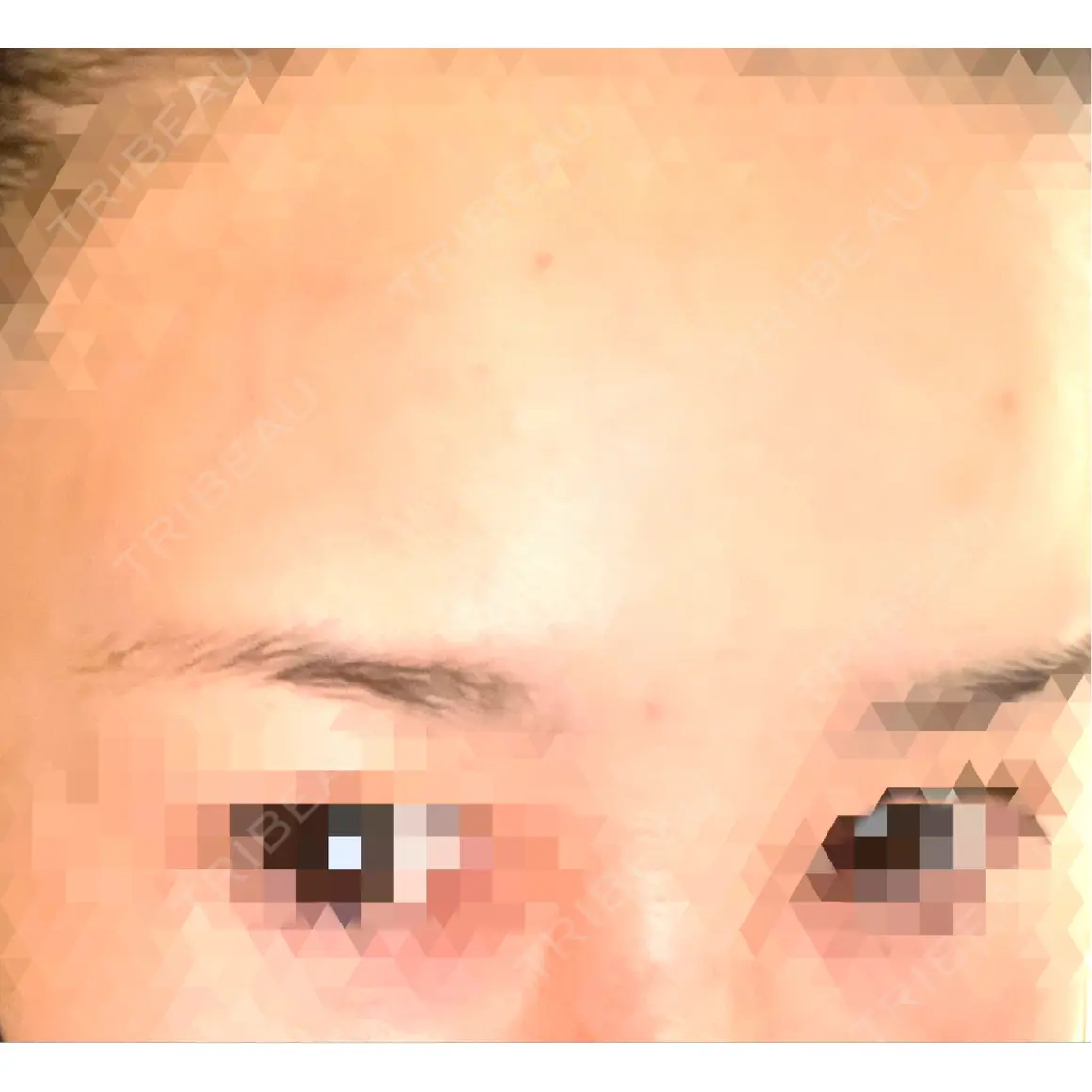 白玉点滴・注射 / シワ取りボトックス シン・整形外科 綱島 AFTER