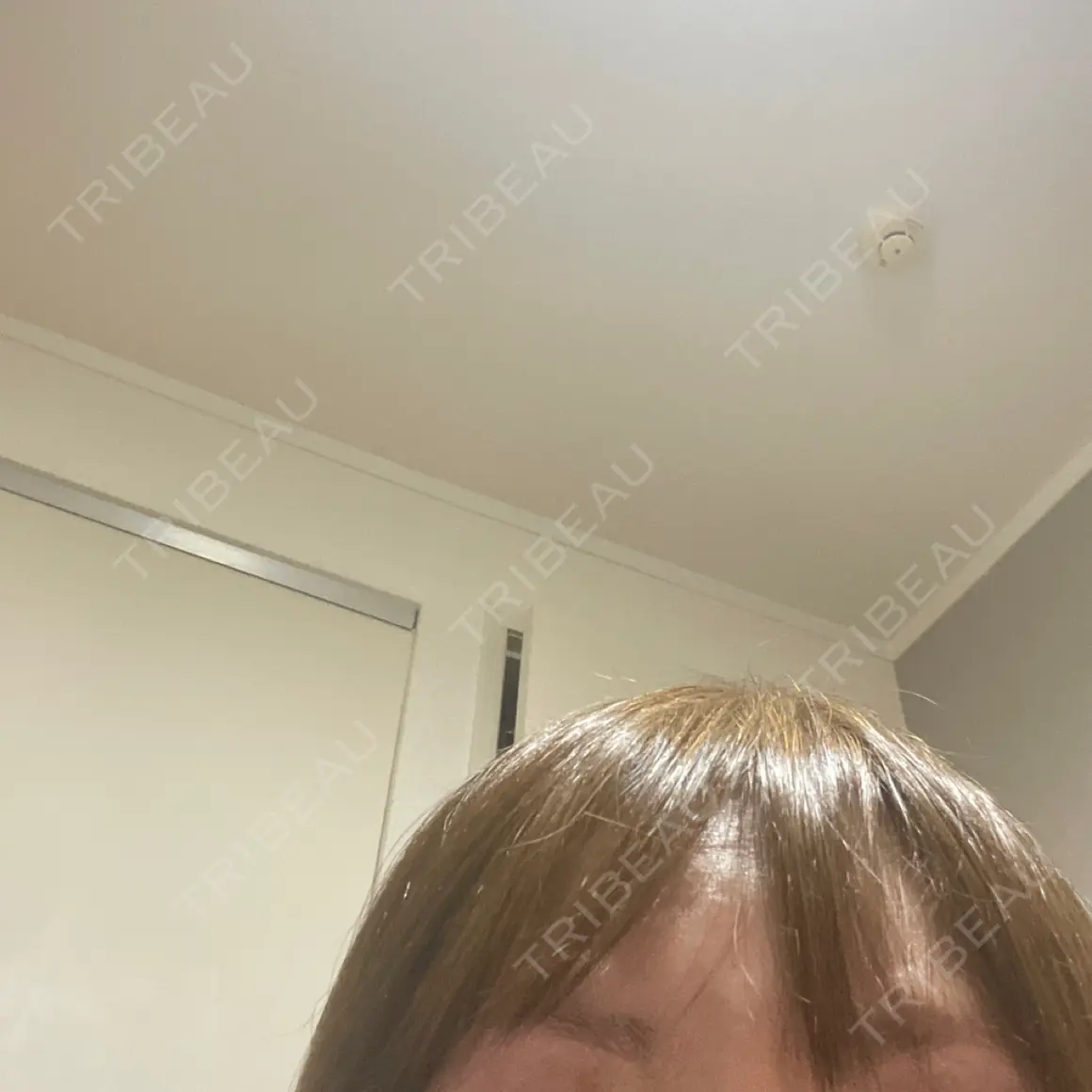 ボトックス（眉間） / ボトックス（目尻） / その他（鼻） TCB東京中央美容外科 前橋院 AFTER