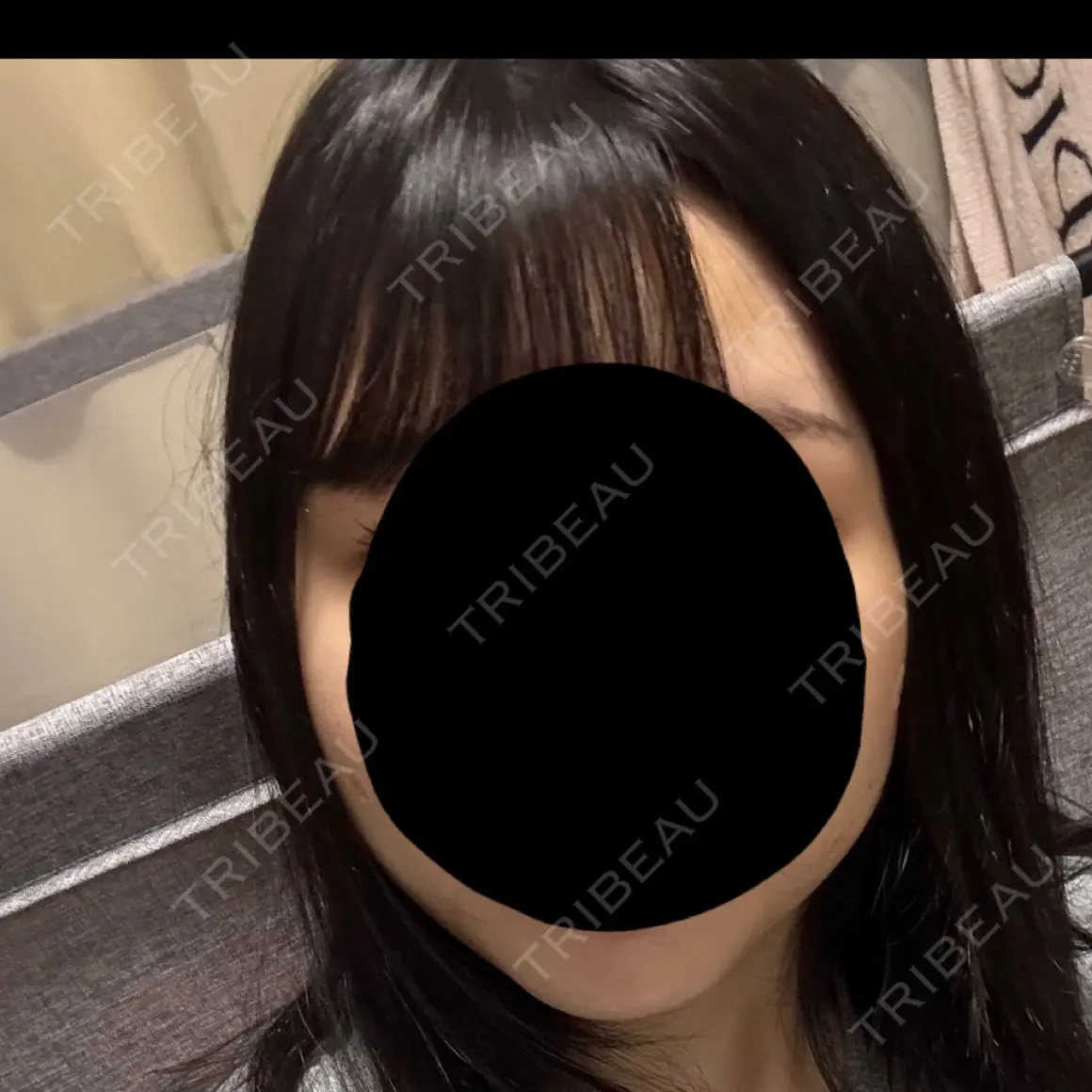 ボトックス（エラ・小顔） フィラークリニック 大阪心斎橋院 AFTER