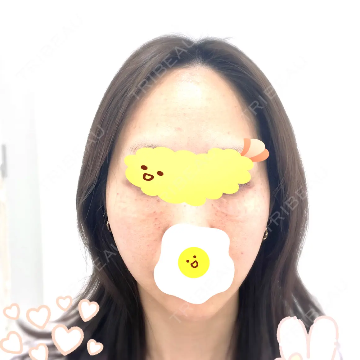 水光注射（ハリ・美肌） GLAMRULE CLINIC (グラムルール クリニック) 銀座院 AFTER