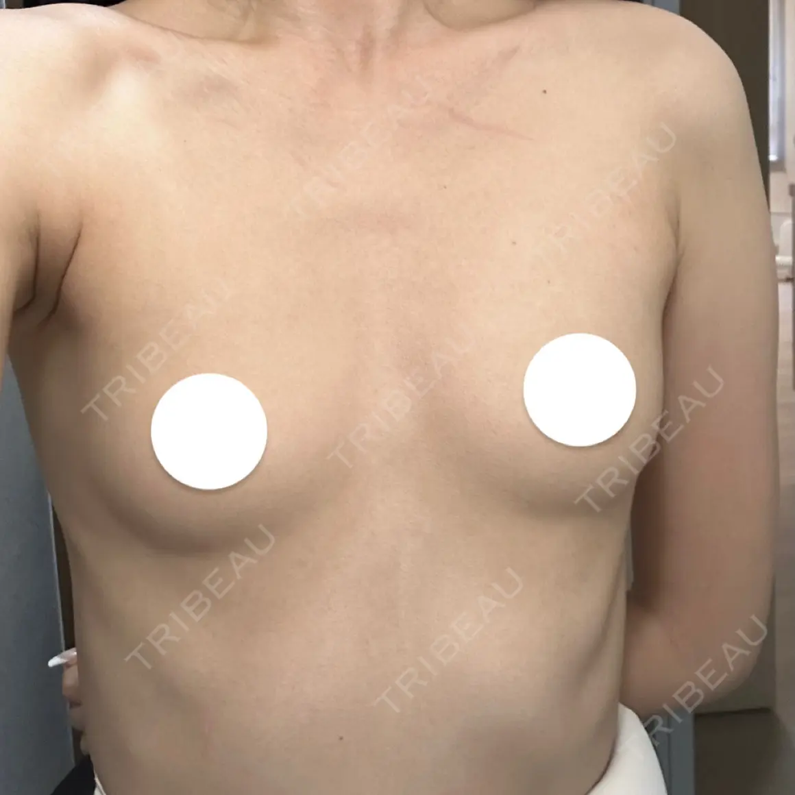 豊胸（脂肪注入） ルーチェクリニック 銀座院 AFTER