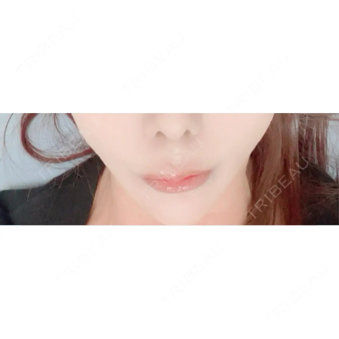 ヒアルロン酸注入（唇） / ボトックス（口角） ルラ美容クリニック 大宮院 / ルラスキンクリニック 大宮院 AFTER