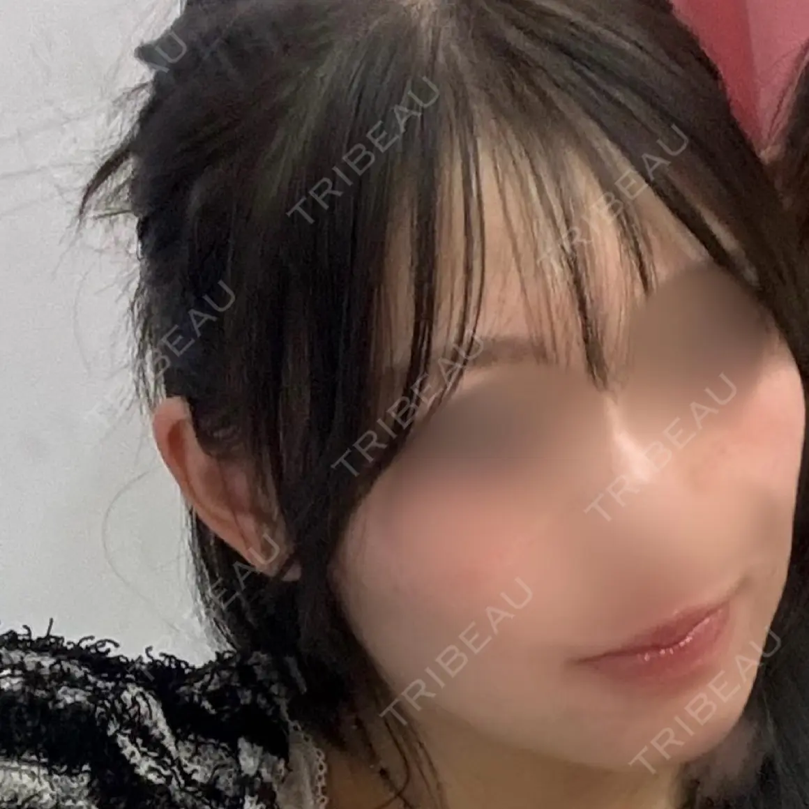 ハイフ（顔） DAILY SKIN CLINIC 福岡院 AFTER