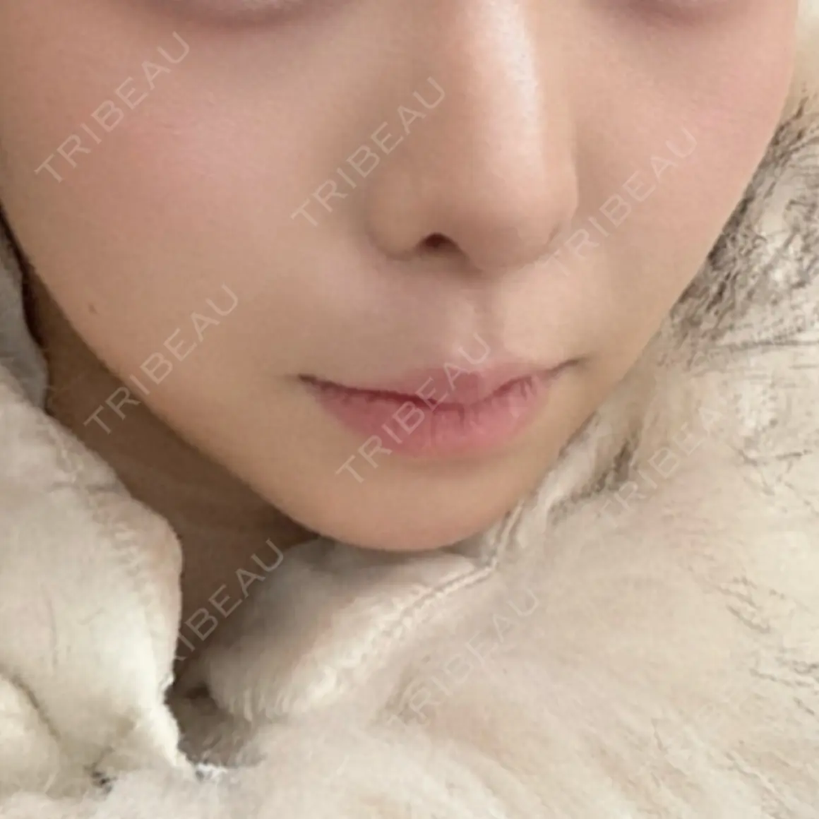 ヒアルロン酸注入（涙袋） / ヒアルロン酸注入（唇） / ボトックス（口角） HAAB×DREAM BEAUTY CLINIC 大阪梅田院 AFTER