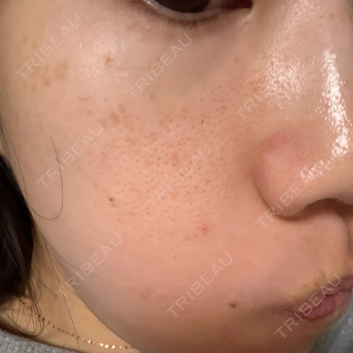 ピコレーザートーニング（美白・肝斑） / ピコフラクショナルレーザー（毛穴・ニキビ跡） APスキンクリニック銀座 AFTER