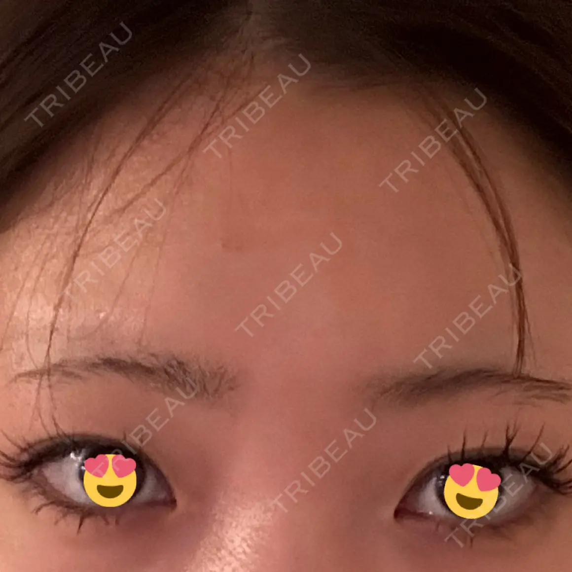 ヒアルロン酸注入（涙袋） Code Beauty Clinic 名古屋院 AFTER