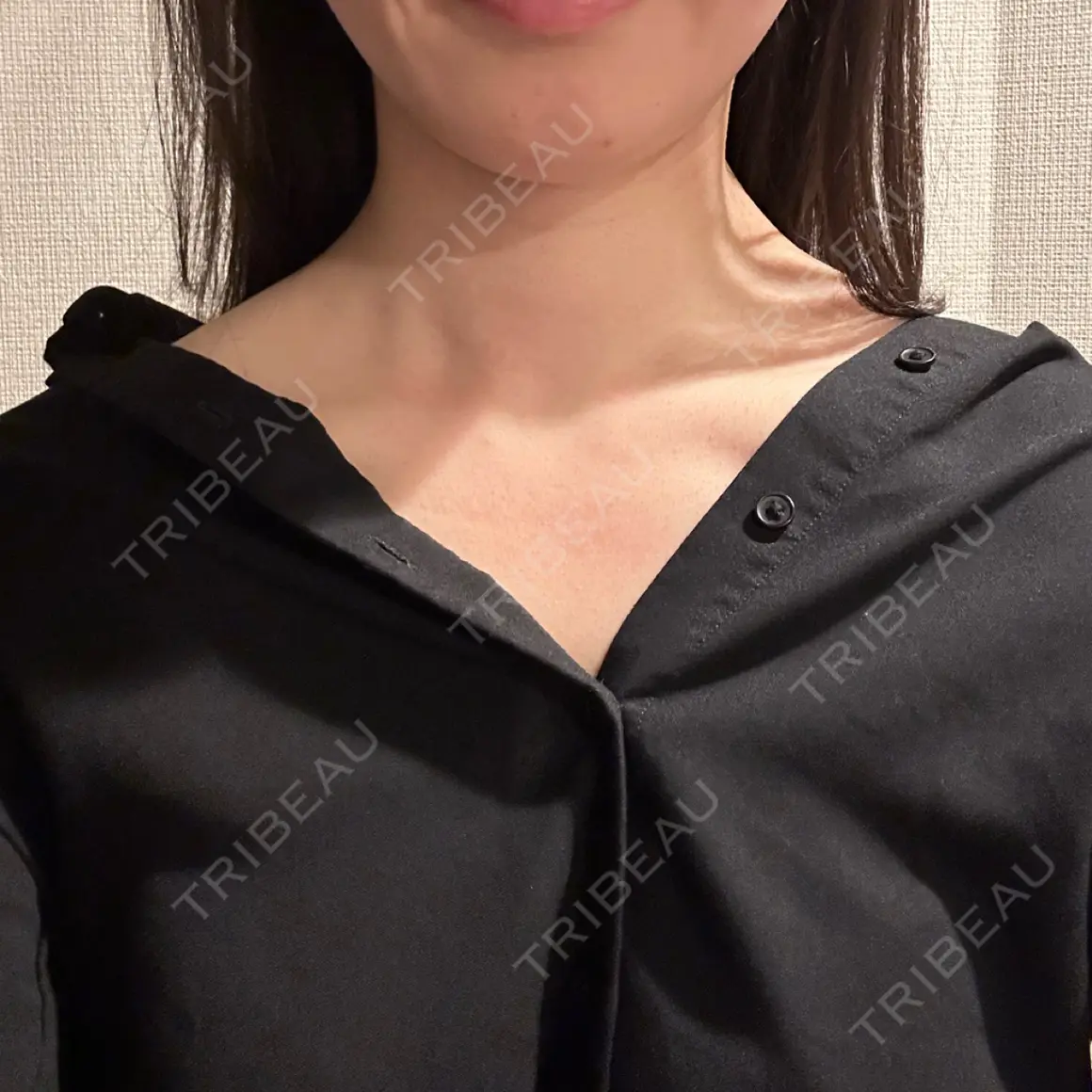 ボトックス（肩） 新未来クリニック AFTER