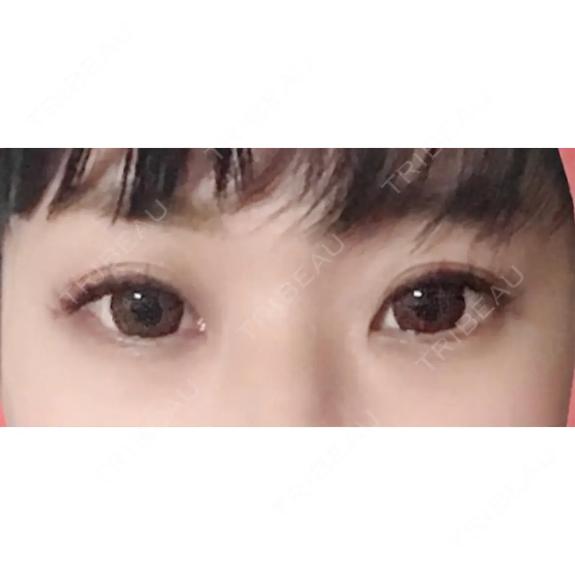 ヒアルロン酸注入（涙袋） さっぽろ美容クリニック AFTER