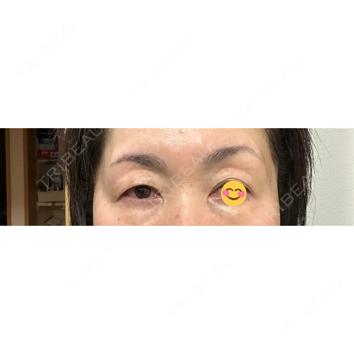 二重切開 / 眼瞼下垂（切開） / 上まぶたたるみ取り 東京シンデレラ美容外科 新宿院 AFTER