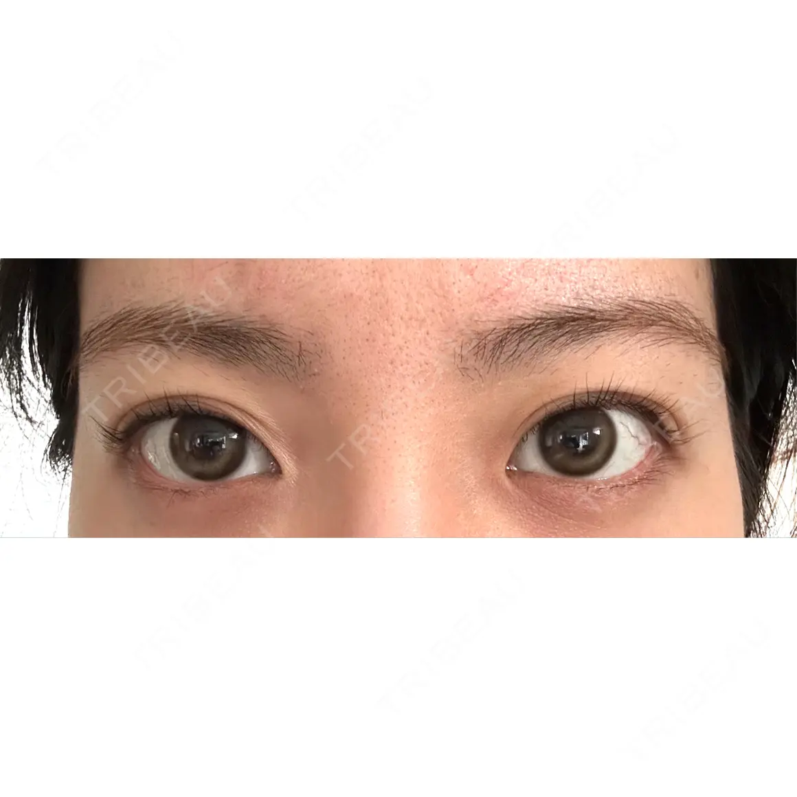 目頭切開 HAAB×DREAM BEAUTY CLINIC 東京本院 AFTER