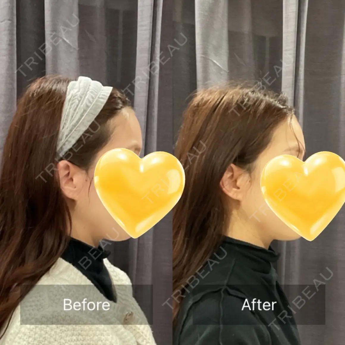 その他（輪郭） ビューティー和心クリニック 浅草院 AFTER