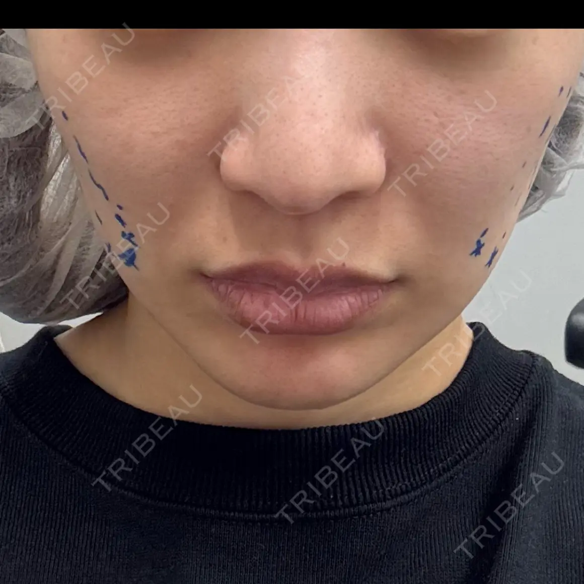 糸リフト 9BeautyClinic AFTER
