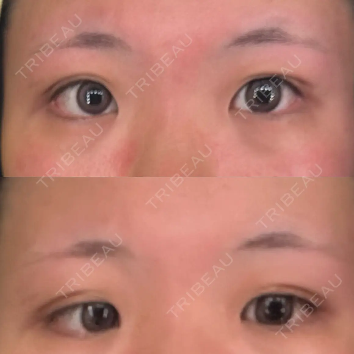 二重埋没 / 目頭切開 東京BELLEZZAクリニック AFTER