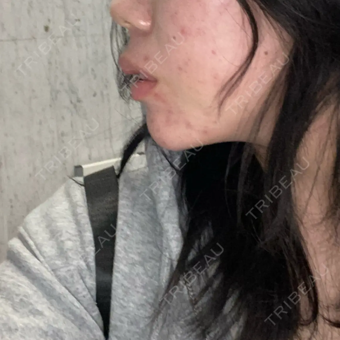 ボトックス（肩） / ヒアルロン酸注入（鼻翼基部） DMTC美容皮膚科 大宮院 AFTER