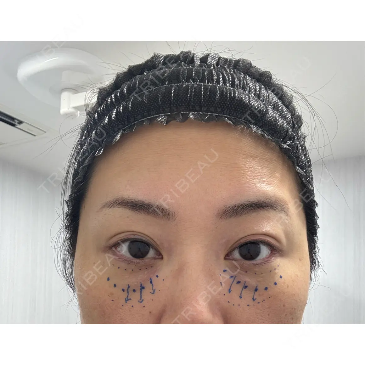 クマ治療 EMMO FACE CLINIC 東京三田院 AFTER