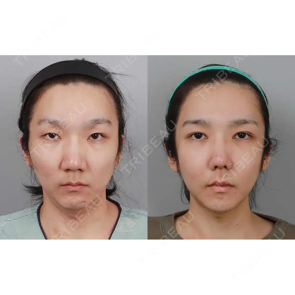 二重切開 / 目頭切開 / 鼻中隔延長（切開） / 小鼻縮小（切開） / 骨切り（あご） / 骨削り（エラ） / 骨削り（頬） / 額を丸く / 軟骨移植 / 骨切幅寄せ / ワシ鼻修正・ハンプ切除 / 輪郭修正 / 脂肪注入（額） / 脂肪注入（輪郭） セギム美容整形外科 AFTER
