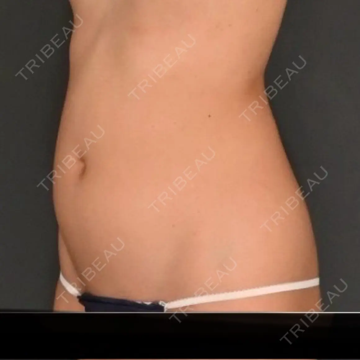 脂肪吸引（お腹） / 豊胸（脂肪注入） / 脂肪吸引（腰） Lipo Clinic omotesando AFTER