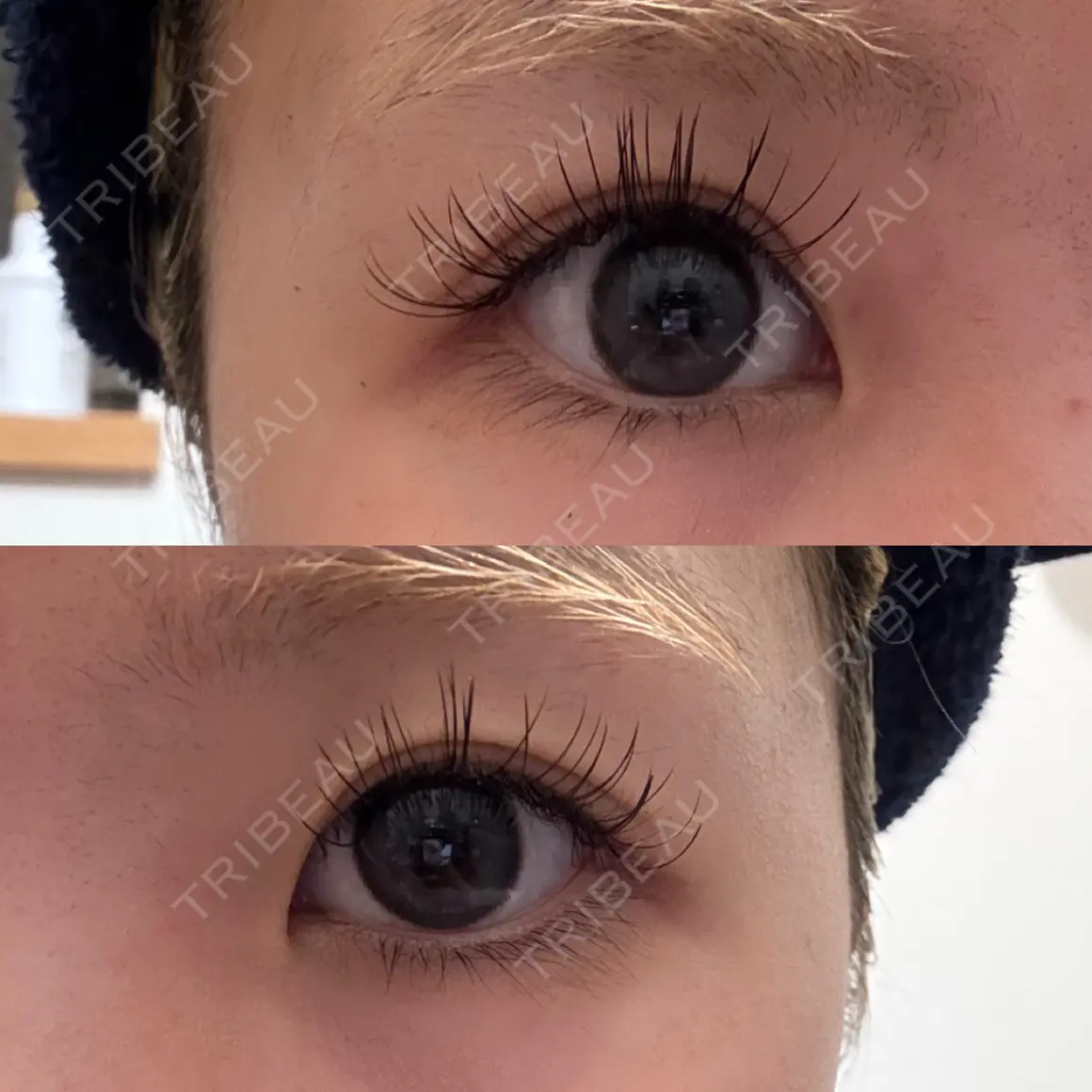目頭切開 9BeautyClinic AFTER