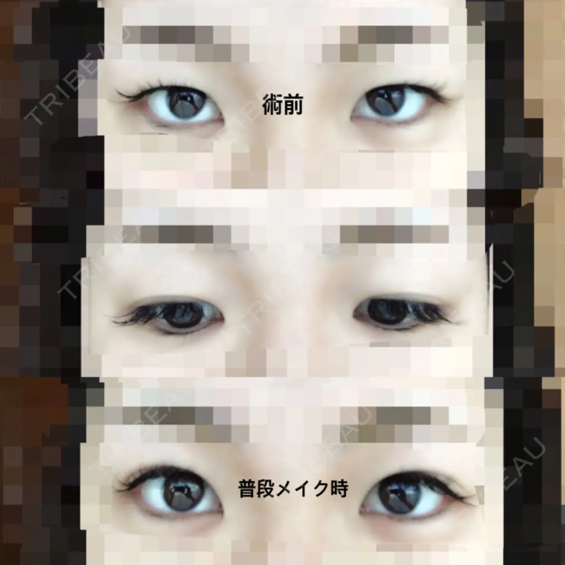二重埋没 湘南美容クリニック 新宿本院 AFTER
