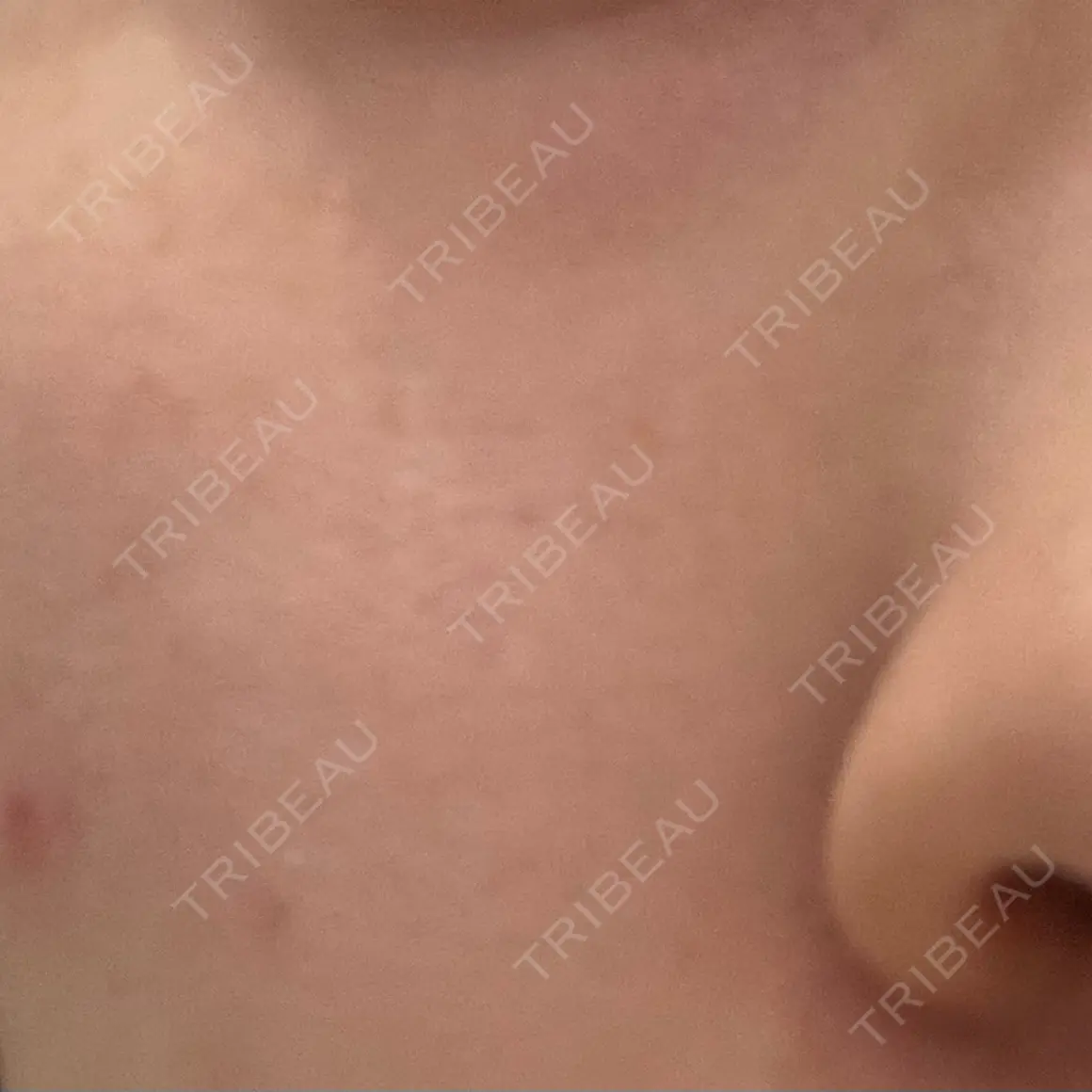 ピーリング（ハリ・ツヤ） / ルメッカ PureMe Skin Clinic（ピュアミースキンクリニック麻布） AFTER