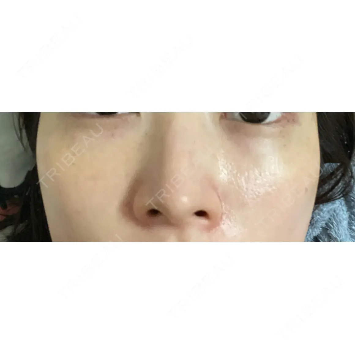 ルメッカ PureMe Skin Clinic（ピュアミースキンクリニック麻布） AFTER