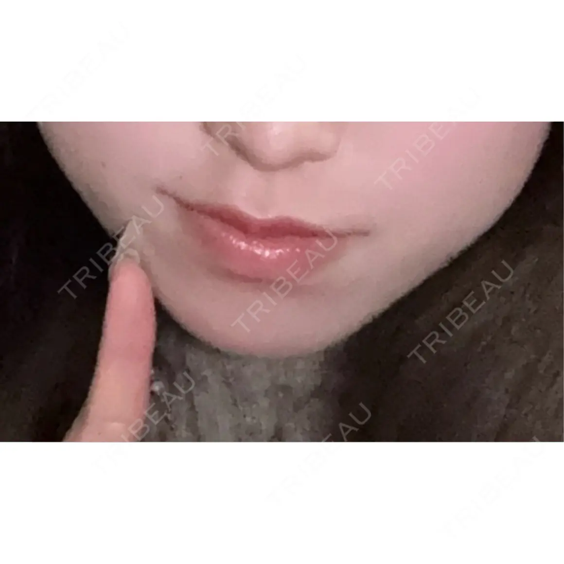 ヒアルロン酸注入（あご） / ボトックス（エラ・小顔） ルラ美容クリニック 横浜院 AFTER