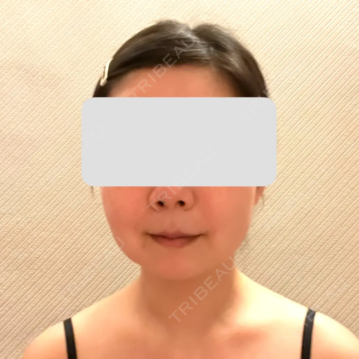 糸リフト / 脂肪吸引（顔） / 脂肪吸引（二の腕） / 脂肪注入（額） 脂肪吸引ラボトウキョウ AFTER