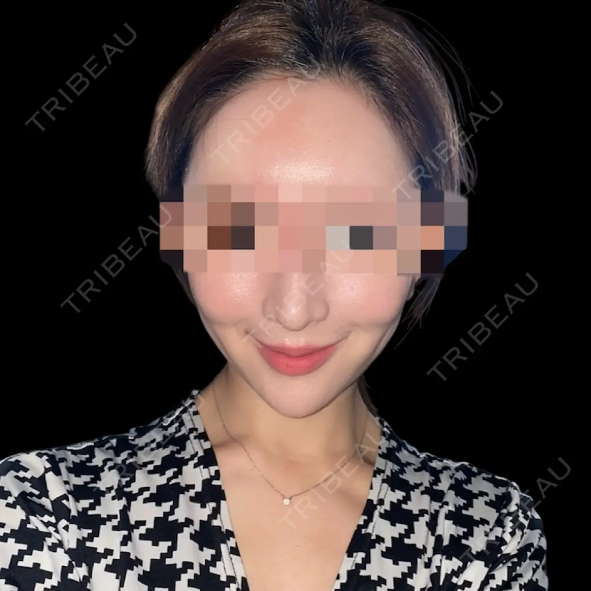 ハイフ（顔） DAILY SKIN CLINIC 福岡院 AFTER