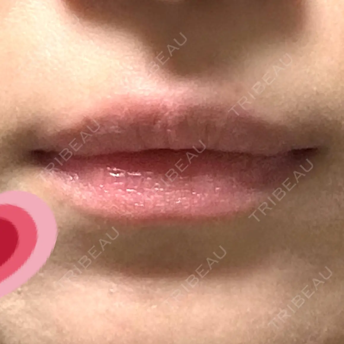ボトックス（口角） WellnessPlus Clinic 【ウェルネスプラスクリニック】 AFTER