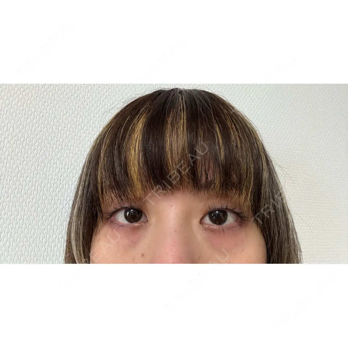 クマ治療 / 脂肪注入（肌） eクリニック 那覇院 AFTER