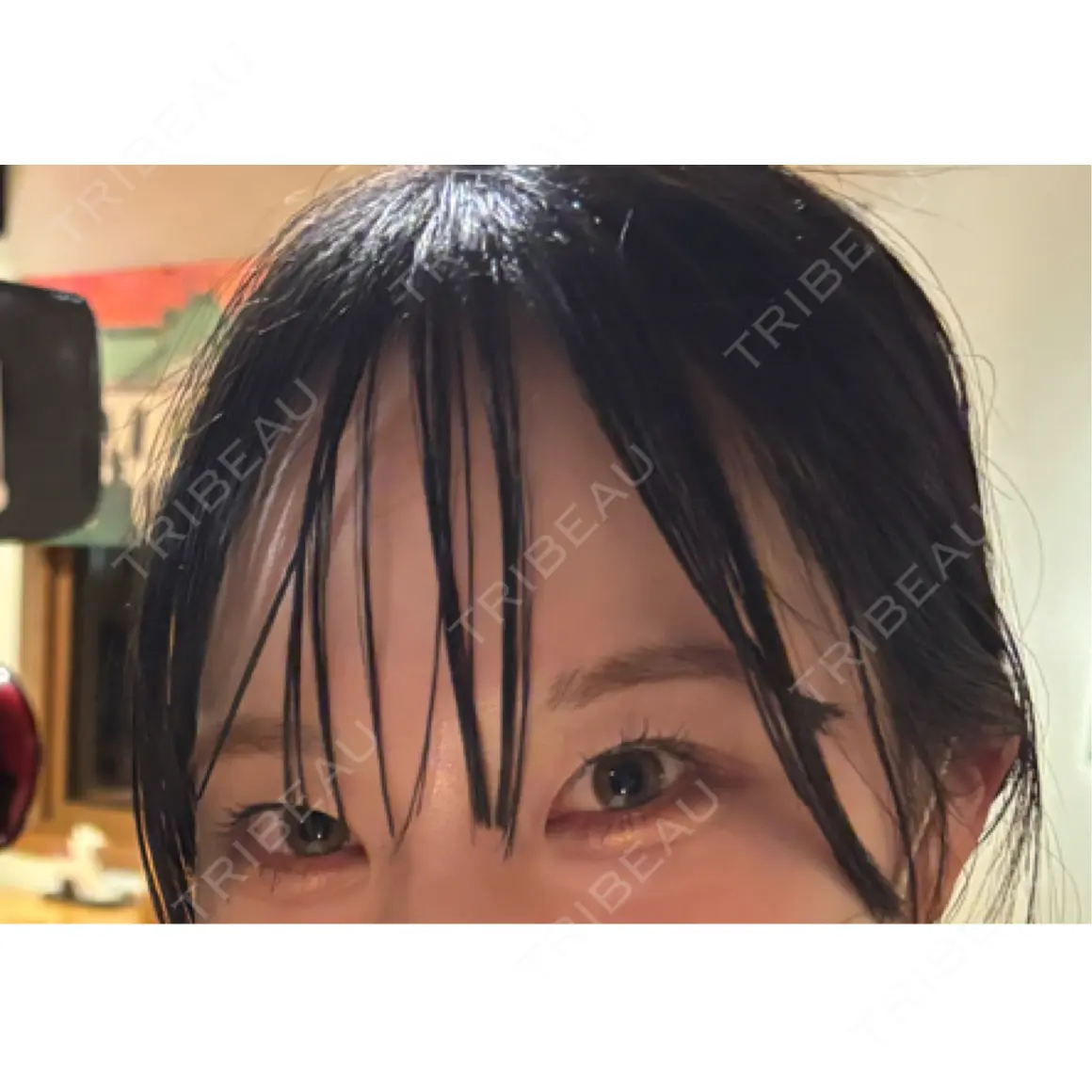 二重埋没 / 目頭切開 HAAB×DREAM BEAUTY CLINIC 東京本院 AFTER