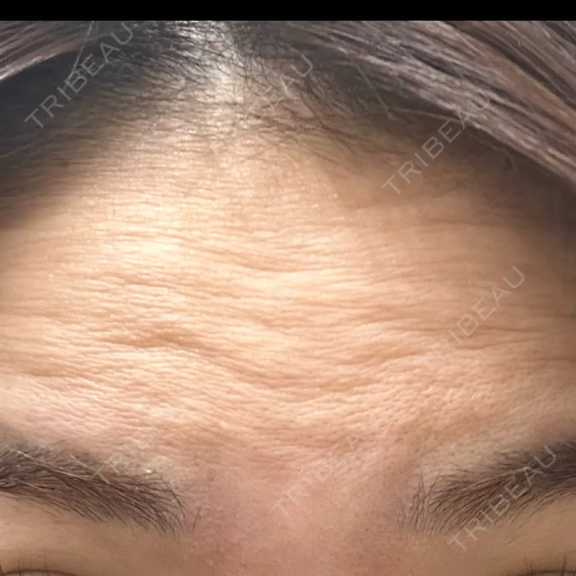ボトックス（額） WellnessPlus Clinic 【ウェルネスプラスクリニック】 AFTER