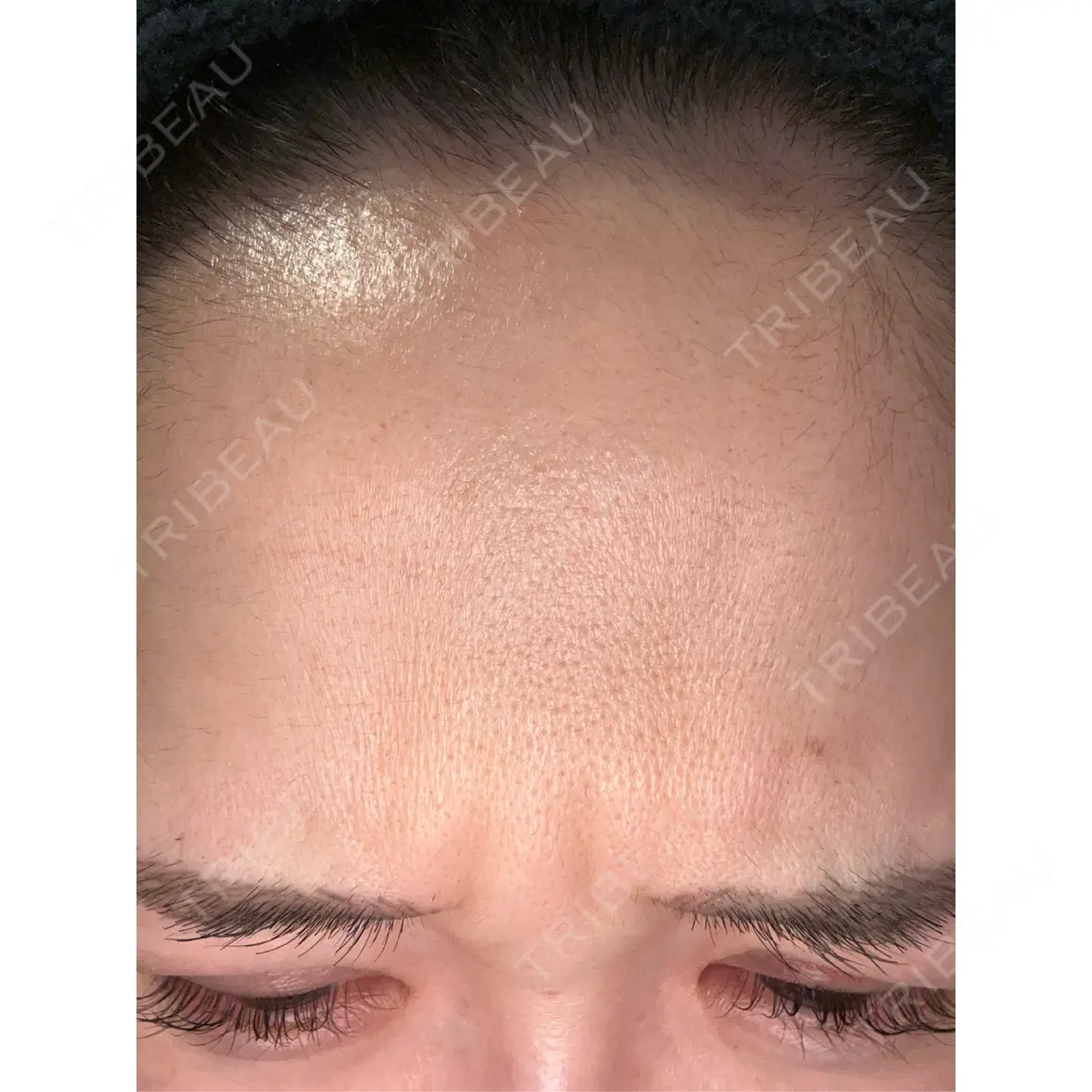 シワ取りボトックス / ボトックス（眉間） / ボトックス（額） Zetith Beauty Clinic 福岡院 AFTER