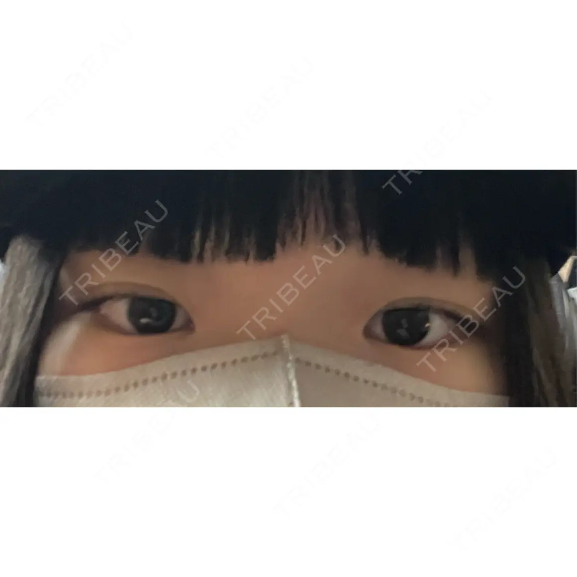 目頭切開 9BeautyClinic AFTER