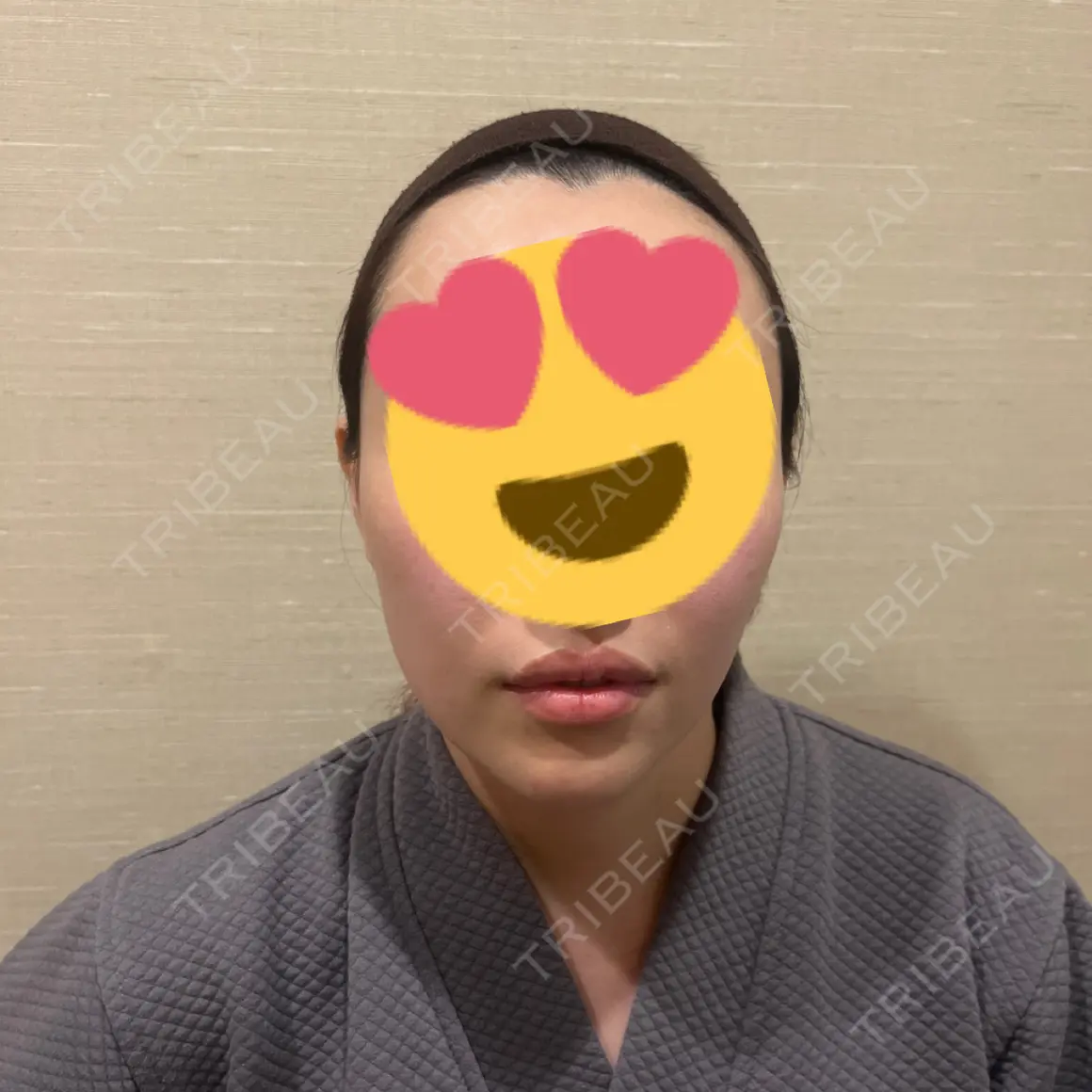糸リフト / 脂肪吸引（顔） / 脂肪吸引（二の腕） / ネックリフト / 脂肪注入（輪郭） AVAN TOKYO 銀座脂肪吸引 クリニック AFTER