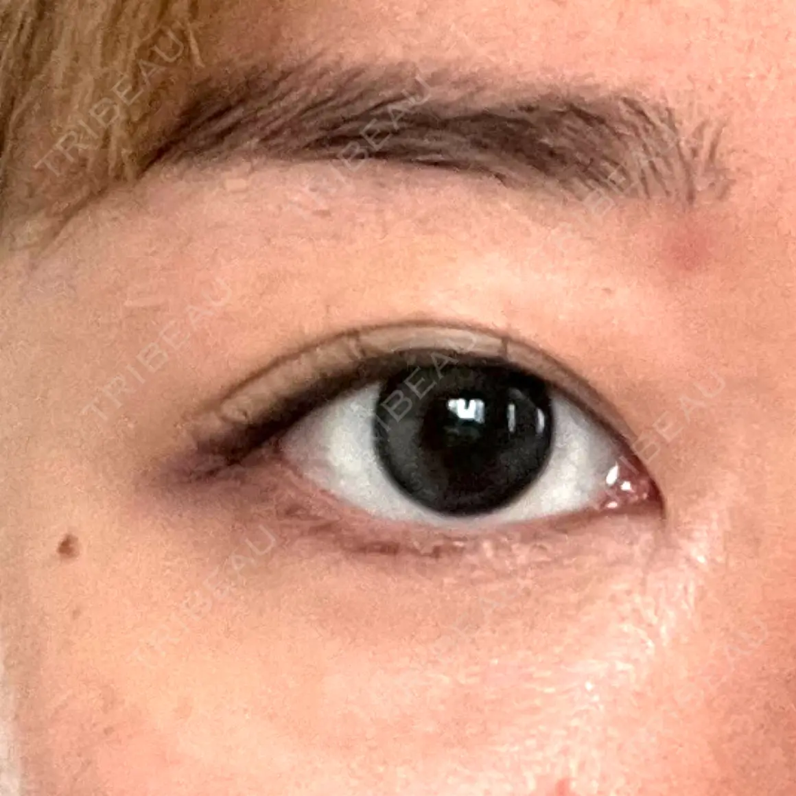 ヒアルロン酸注入（涙袋） oneUPclinic AFTER