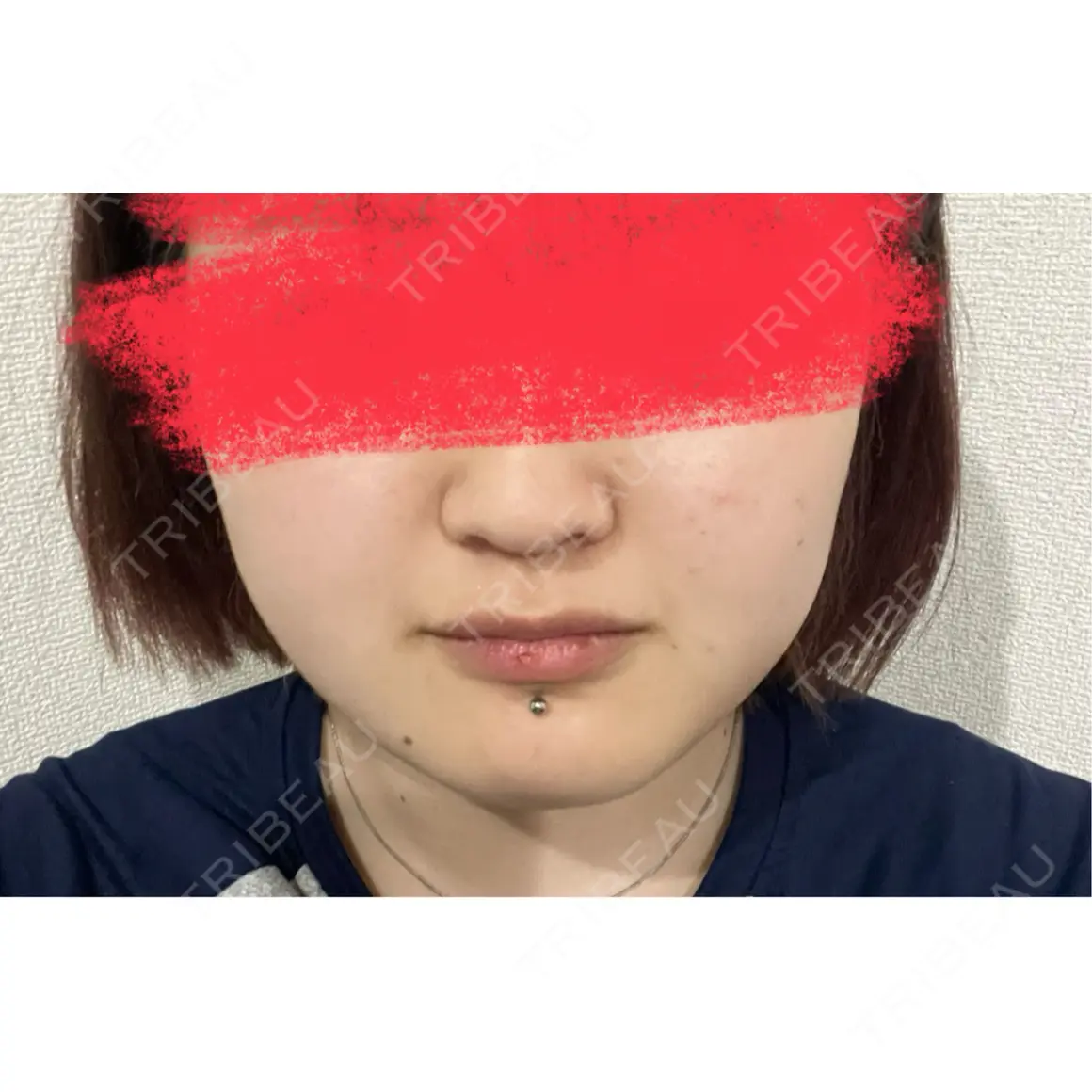 糸リフト / 脂肪吸引（顔） / ボトックス（あご） / その他（輪郭） ziz CLINIC AFTER