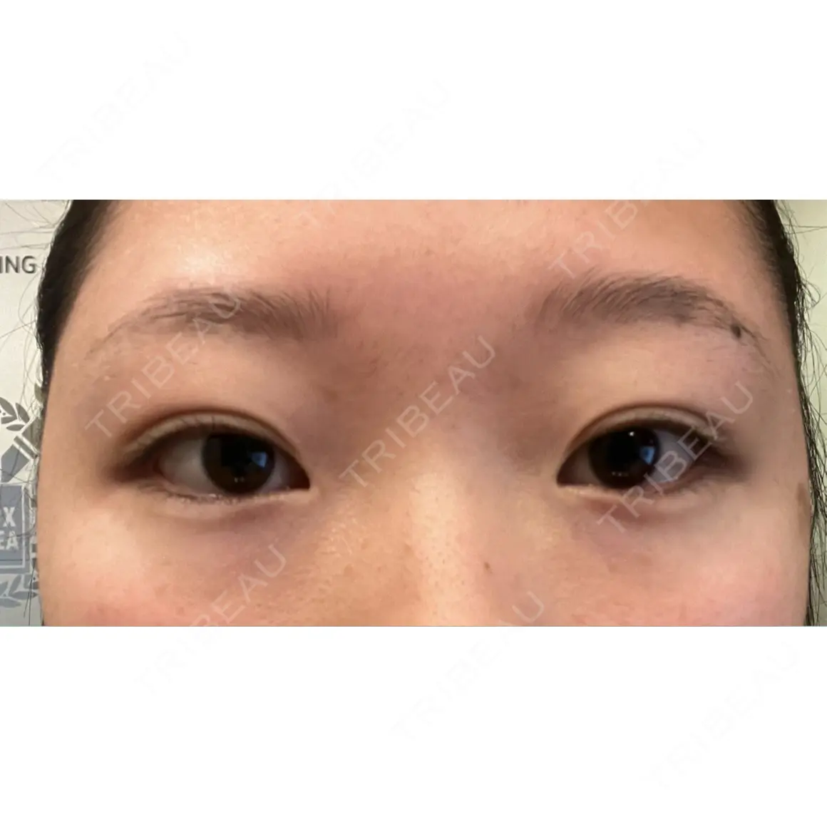 目尻切開 / タレ目形成・グラマラスライン（切開） プロミス整形外科 AFTER