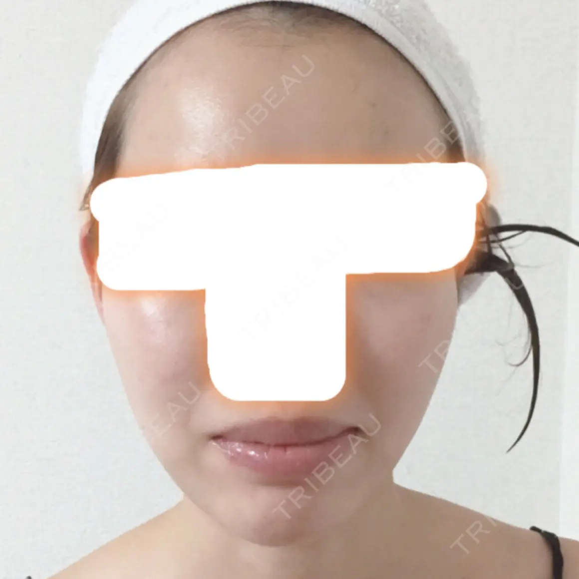 あごプロテーゼ / セットバック / その他（輪郭） / その他（審美歯科/矯正歯科） 大塚美容形成外科・歯科 大塚本院 AFTER