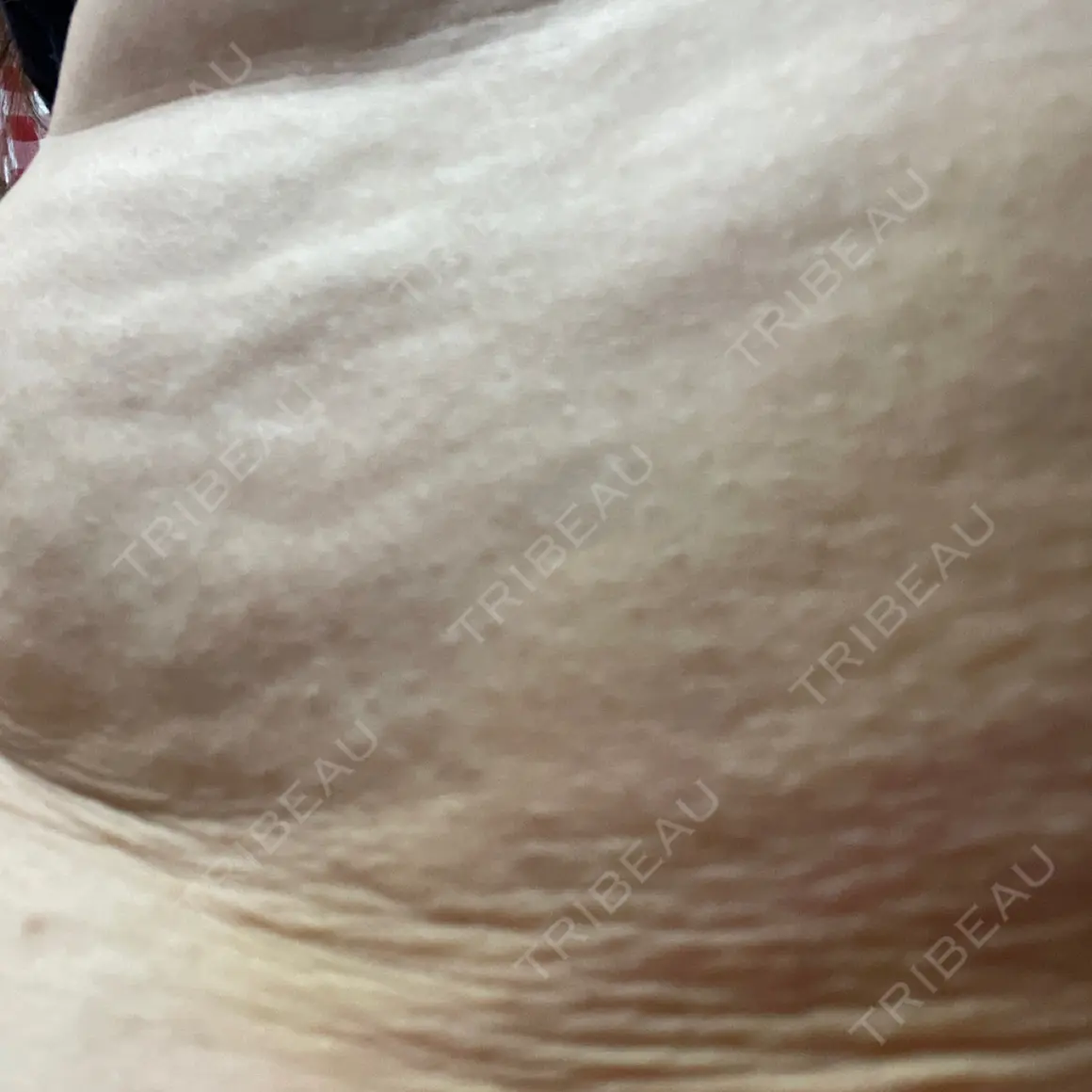 脂肪溶解注射 CLINIC W AFTER