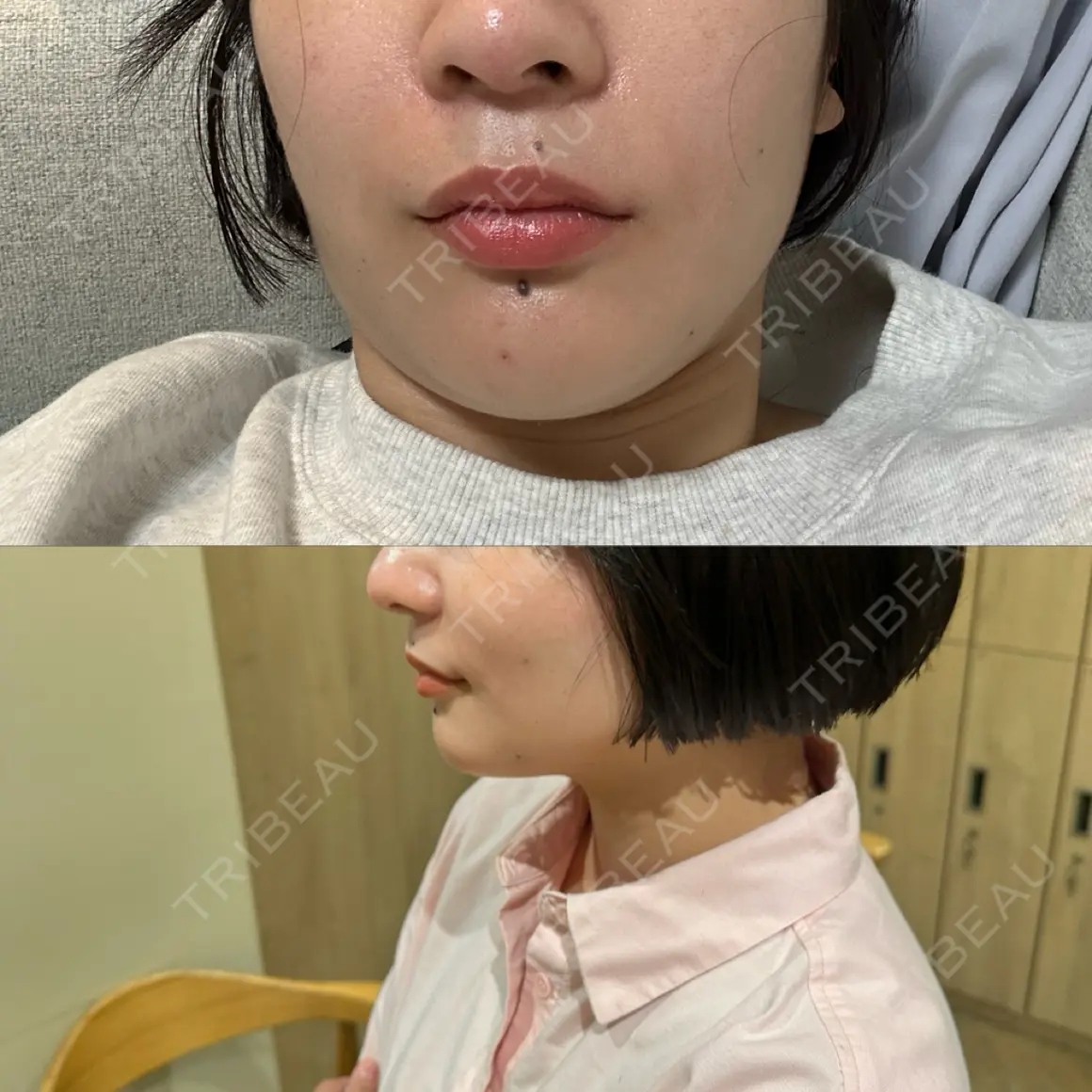 糸リフト / 脂肪吸引（顔） Shion Beauty Clinic AFTER