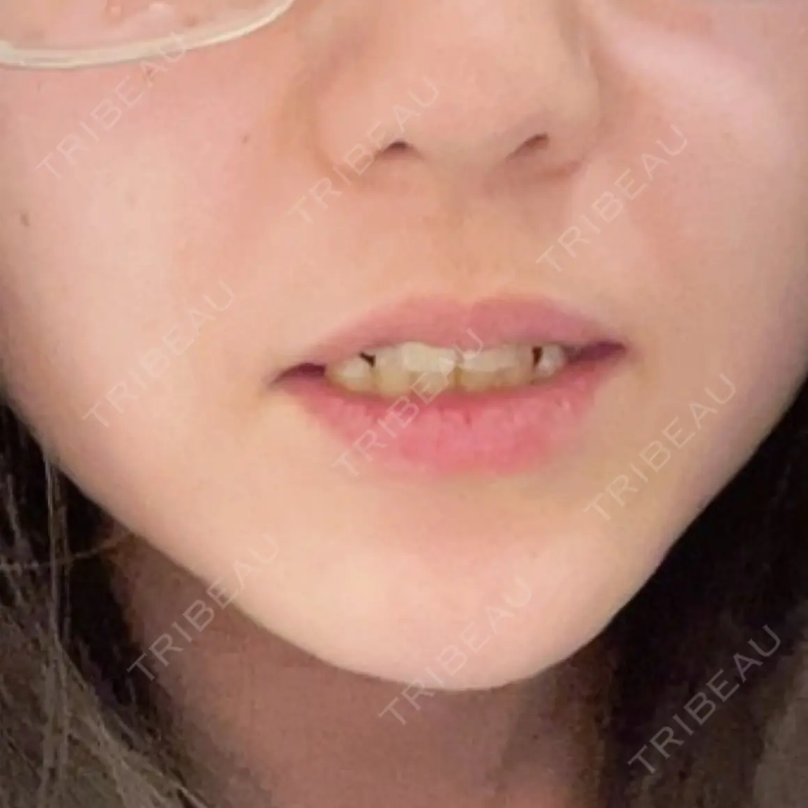 アートメイク（唇） Kinshicho Beauty Clinic （錦糸町ビューティークリニック） AFTER
