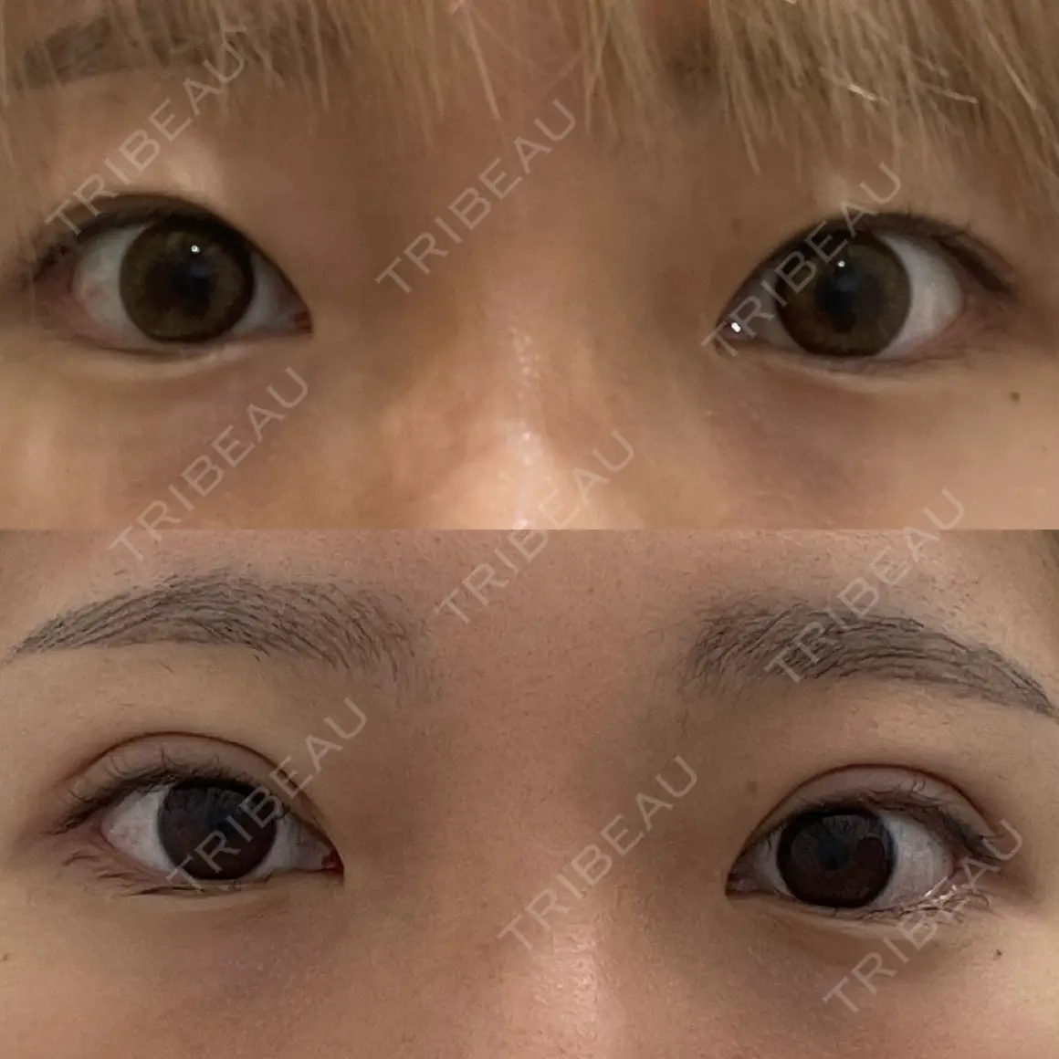 二重埋没 湘南美容クリニック 池袋東口院 AFTER