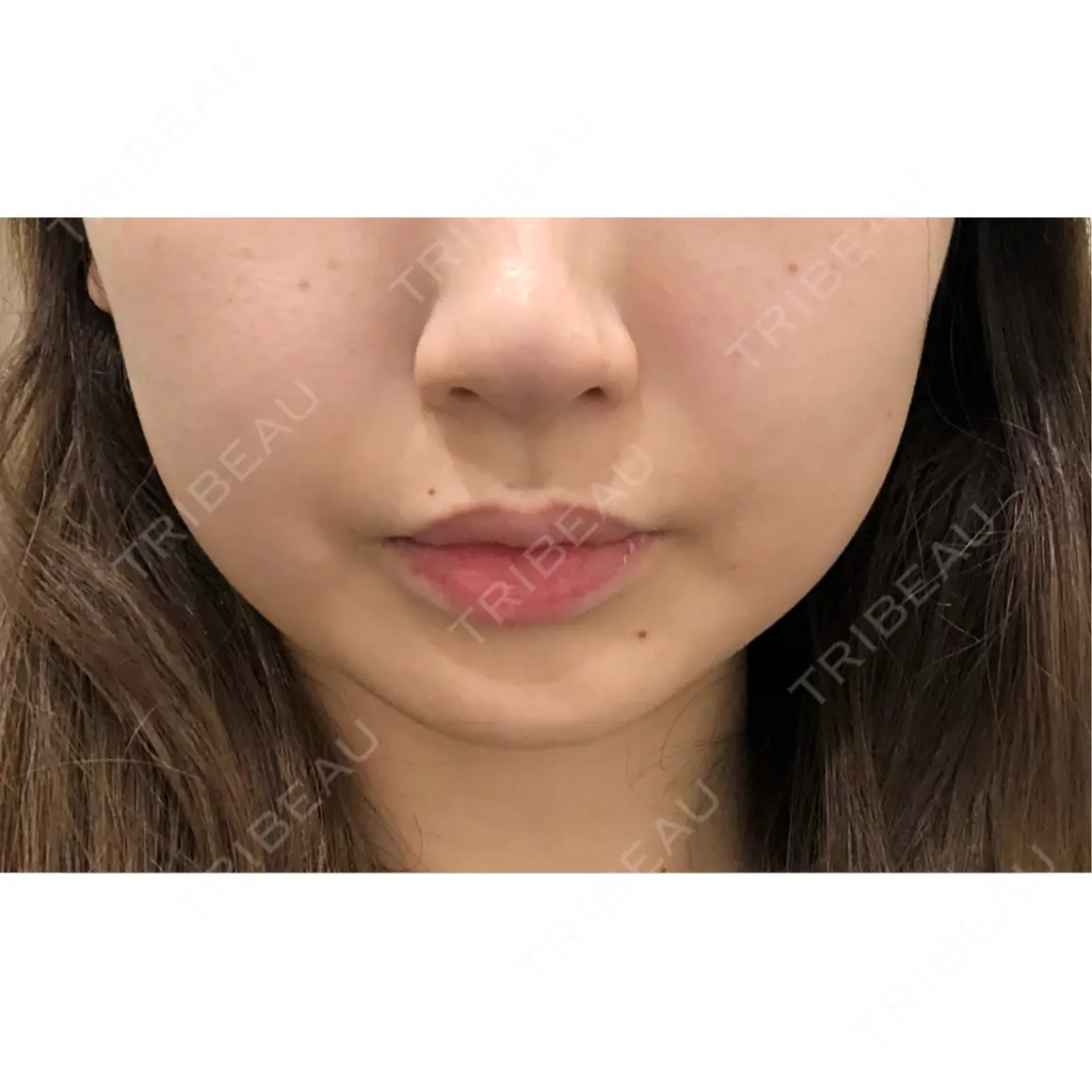 脂肪吸引注射（顔） EMMO FACE CLINIC 東京三田院 AFTER