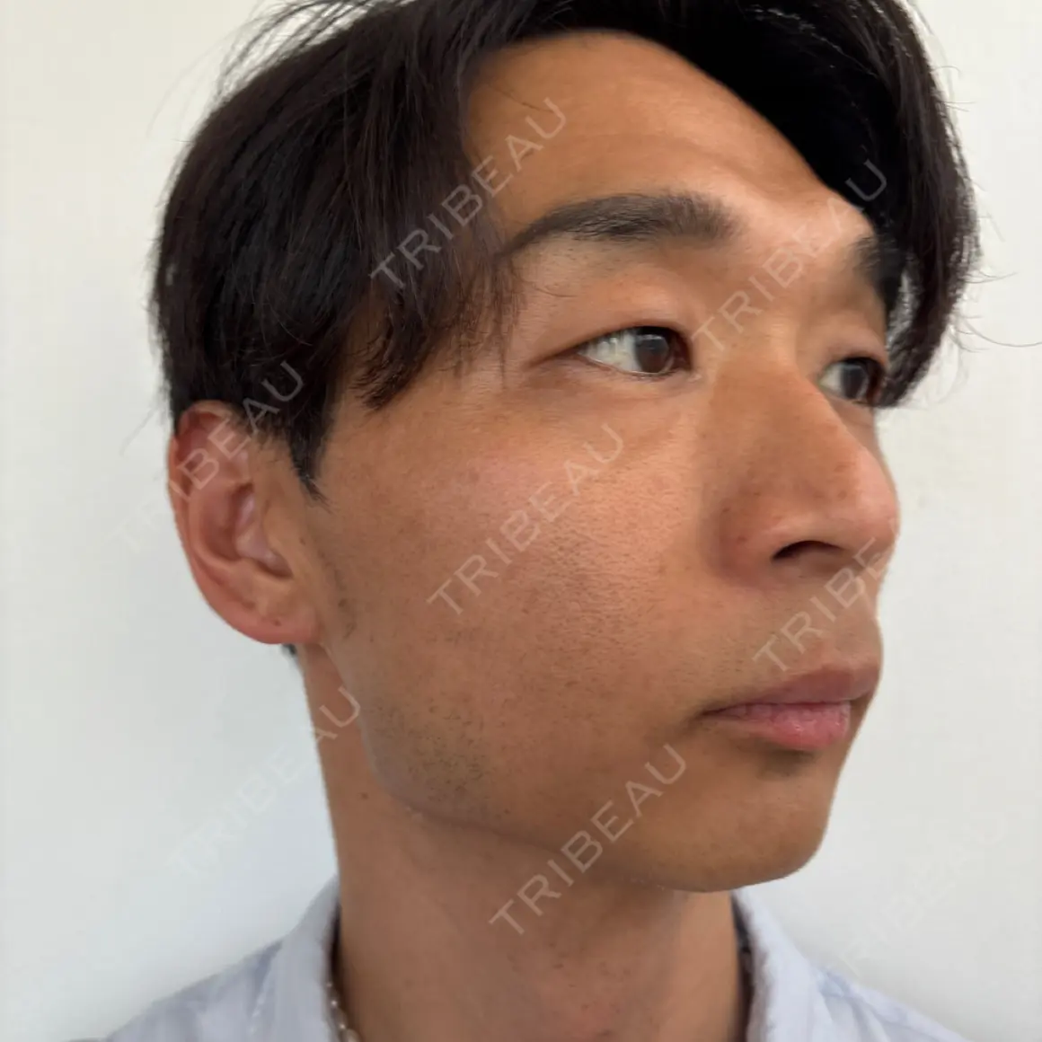 クマ治療 東京形成美容外科 銀座院 AFTER