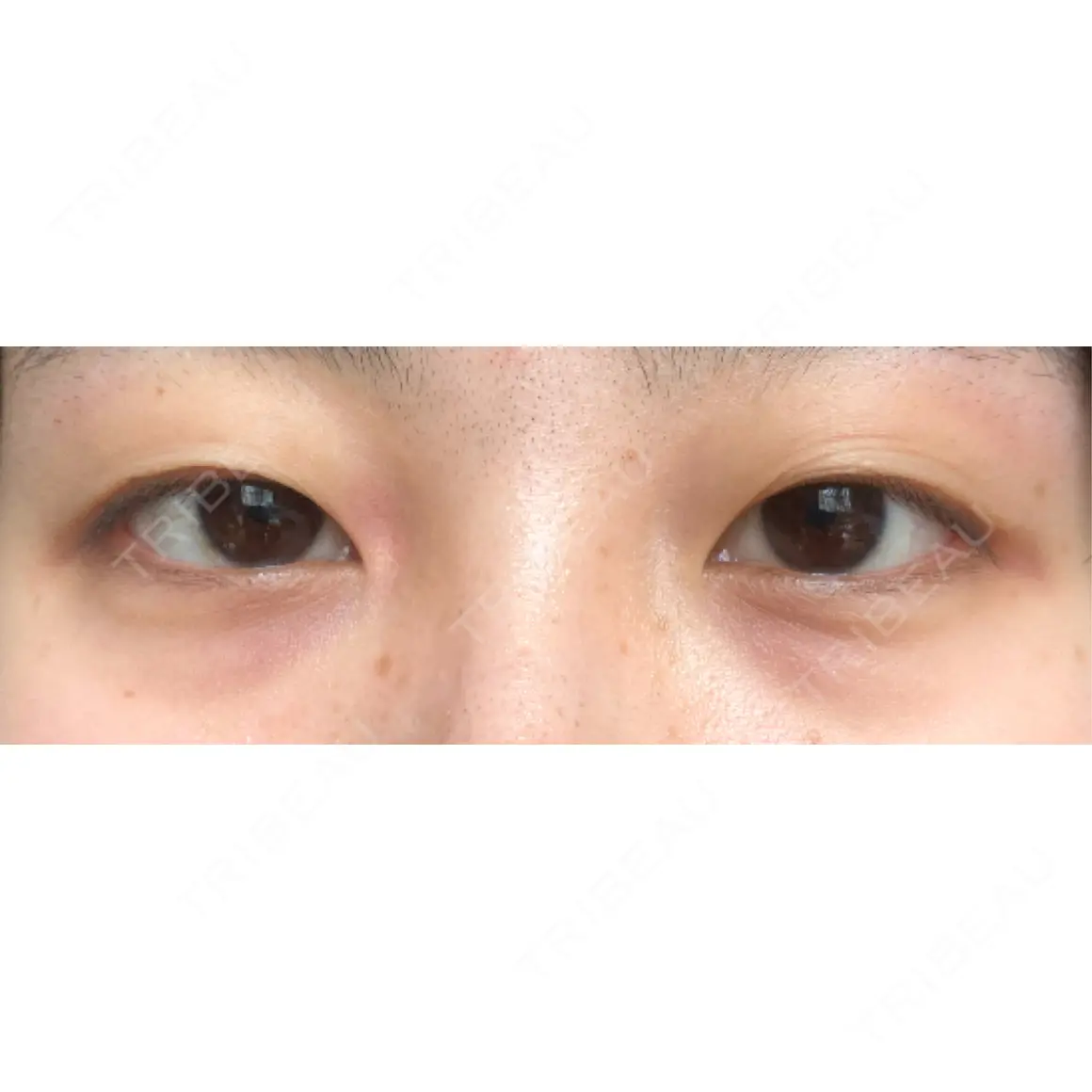二重埋没 オアシス美容外科 AFTER