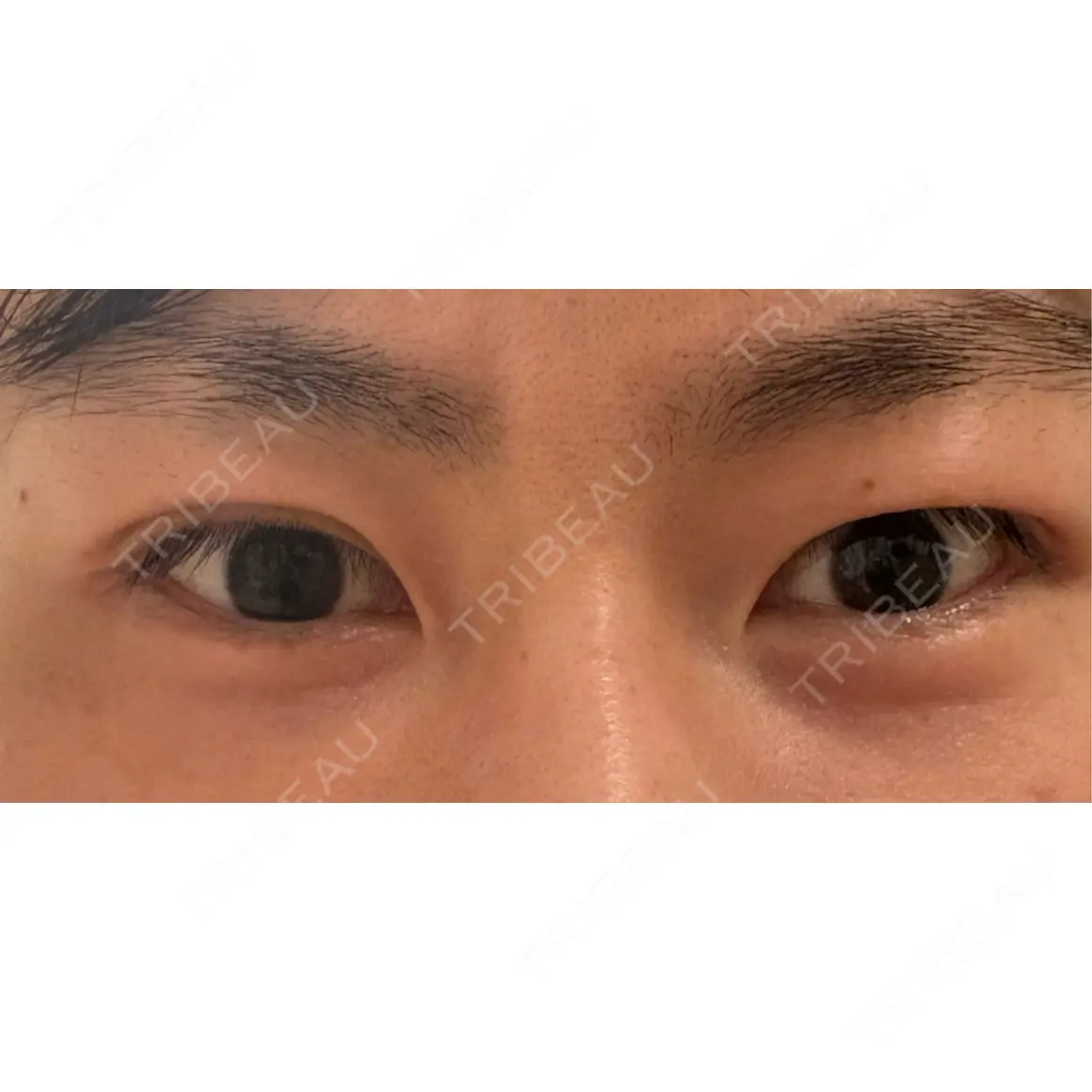 二重埋没 / 上まぶたの脂肪取り アリエル美容クリニック 横浜院 AFTER
